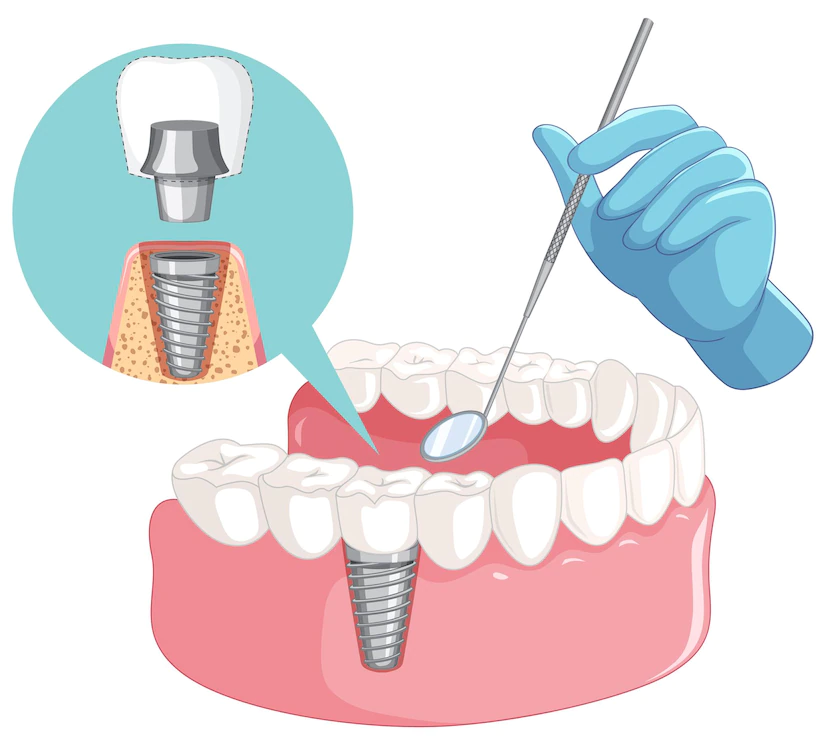 Oral and Maxillofacial Surgery (Extraction and Implant Applications)